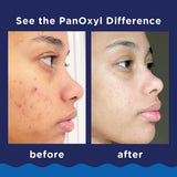 PanOxyl Acne Foaming Wash, 10% Benzoyl Peroxide, For Face & Body, 5.5 oz